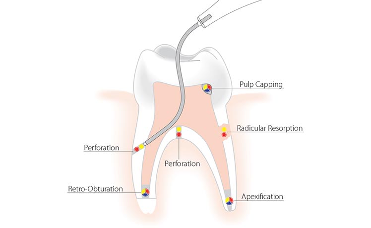 NiTi Memory Shape Needles